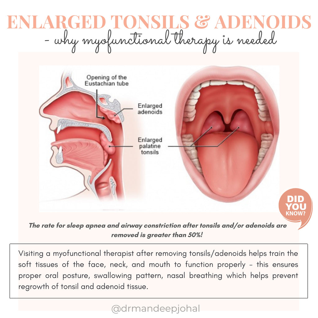 Tonsil Removal and Myofunctional Therapy